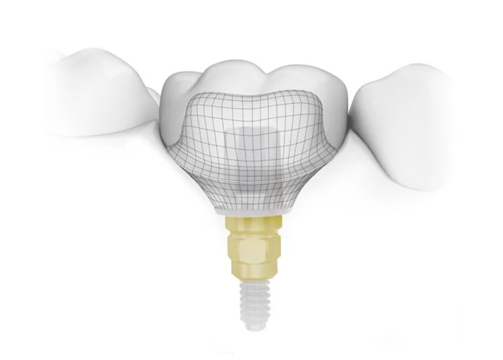 Cutting Edge Dental Implant