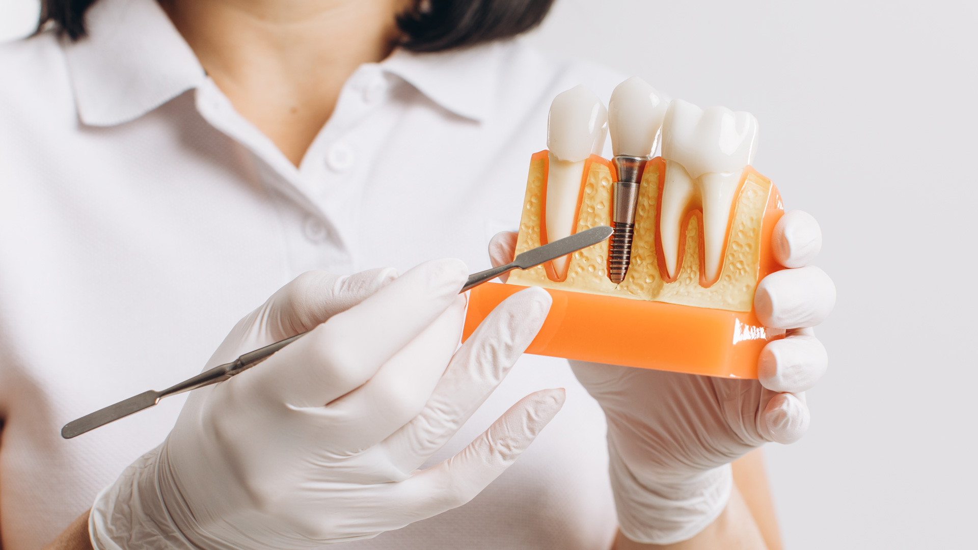 Dental Implants