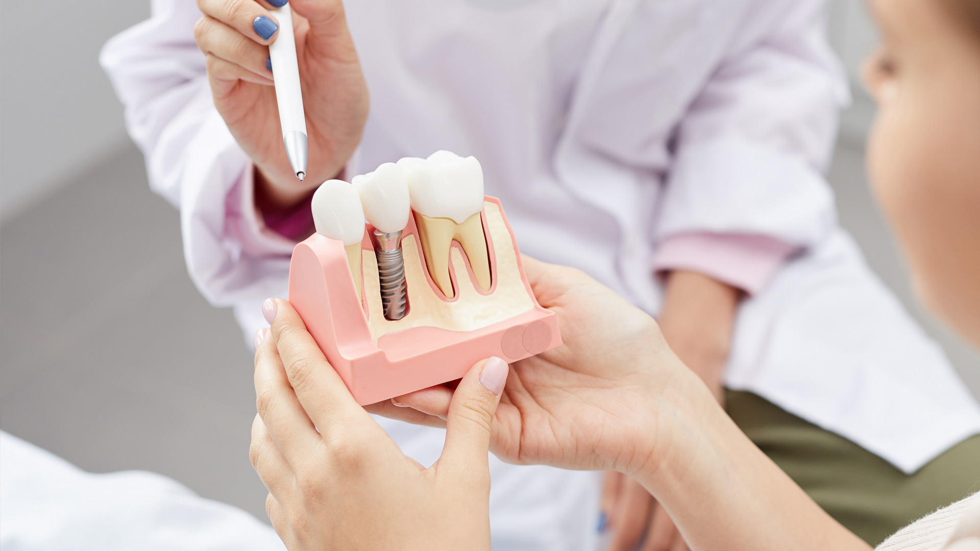 Dental Implants in Noida