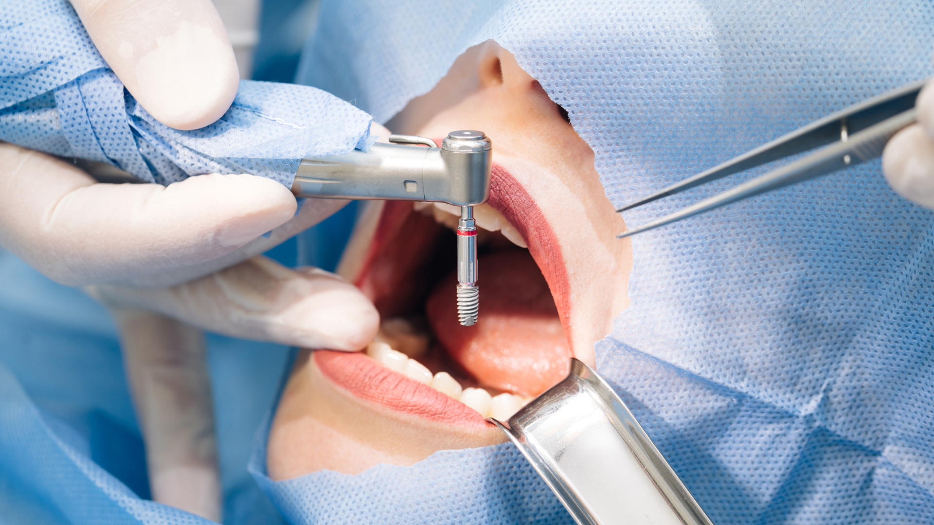 Best Dental Implants in Noida
