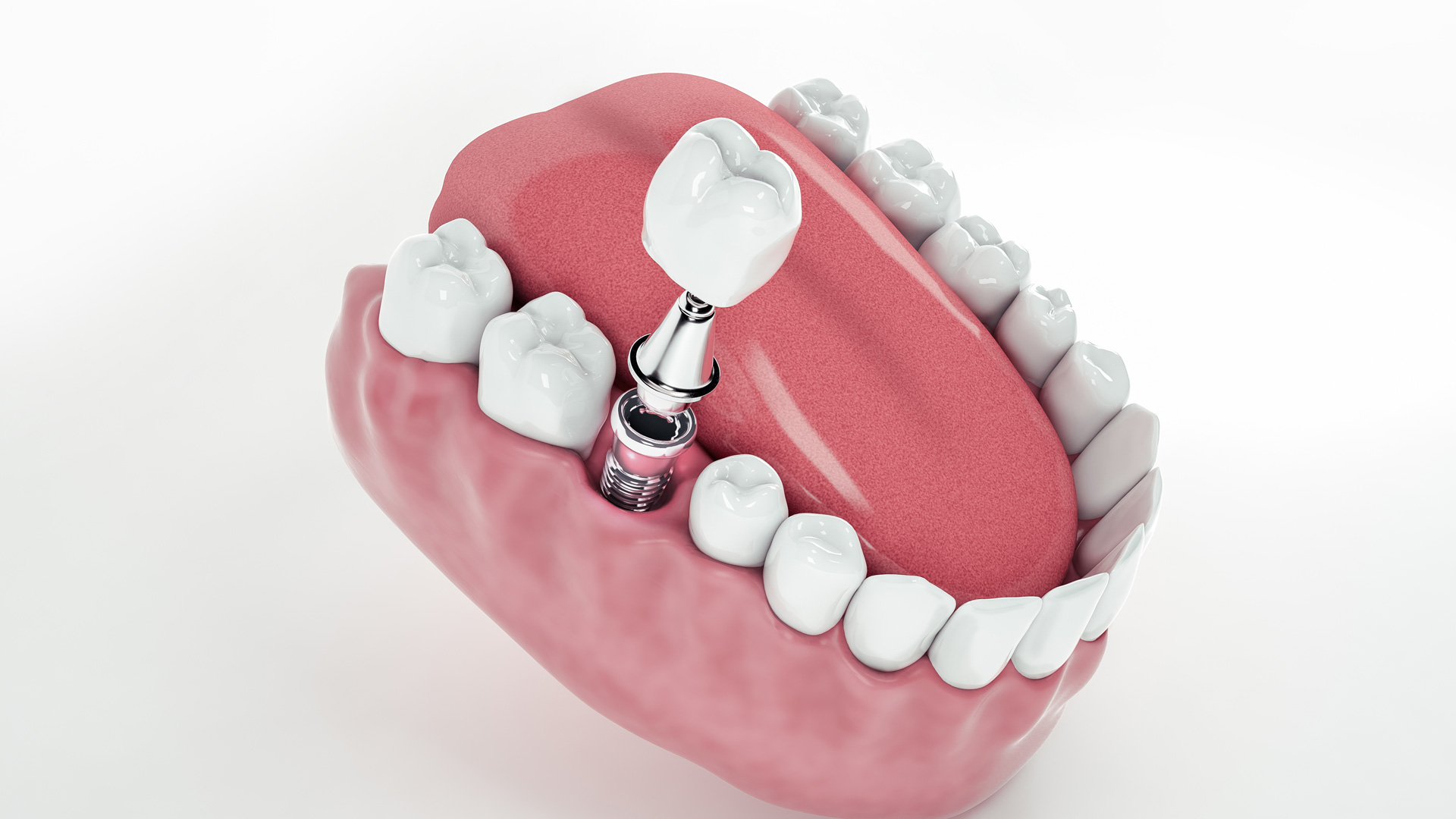 Dental Implant Clinic in Noida